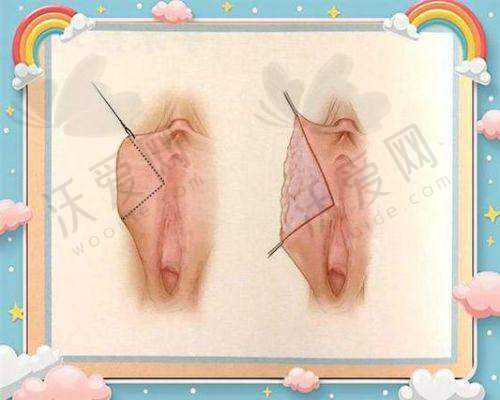 重庆星荣整形肌肉折叠阴道紧缩术适用人群