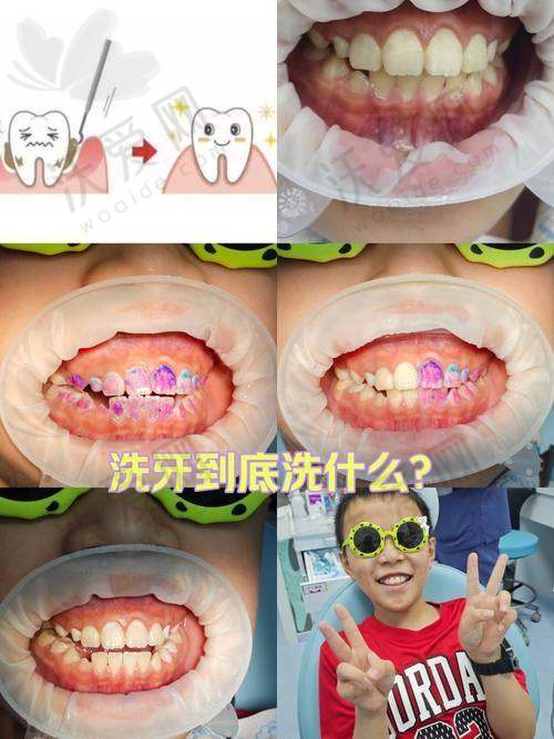 西安团圆口腔超声波洗牙+喷砂+抛光+上药228元起，一站式护齿畅享健康亮白笑容