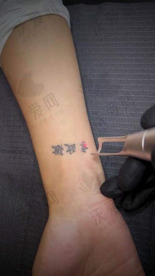 深圳博爱曙光整形洗纹身可靠吗？