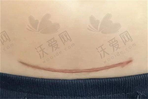 深圳悦尔医美剖腹产增生疤痕治疗1238元起，刘智全医生助您告别疤痕困扰