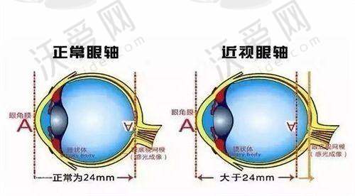 杭州朝聚眼科医院全飞秒激光手术的技术优势有哪些？