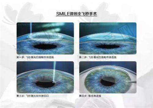 佛山爱尔眼科医院离焦功能眼镜适合哪些人群？