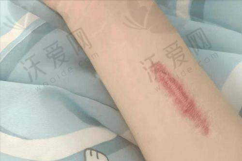 深圳悦尔医疗美容疤痕软化针的技术优势有哪些？
