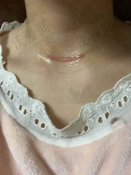 深圳悦尔医疗美容疤痕软化针有成功实例吗？