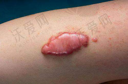 深圳悦尔医美剖腹产增生疤痕治疗价格是怎样的？