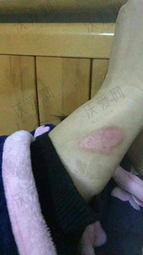 深圳悦尔医疗美容疤痕软化针780元起，多维祛疤方案助你告别疤痕烦恼！