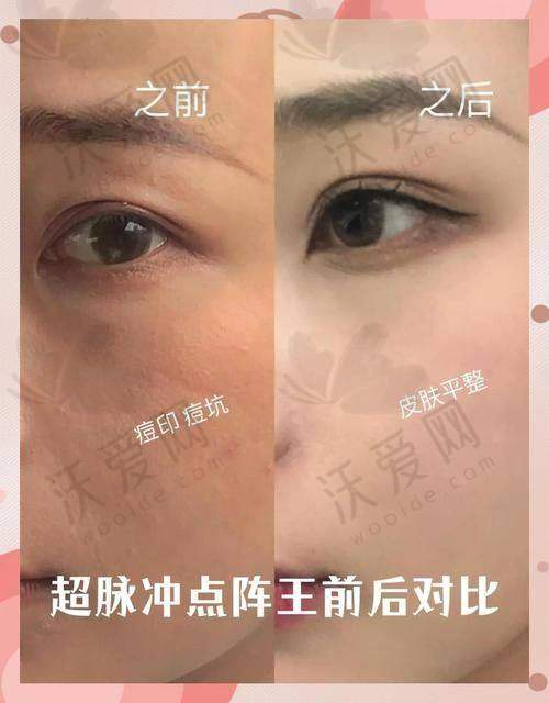 深圳悦尔医美痘坑痘印点阵激光修复术后要注意什么？