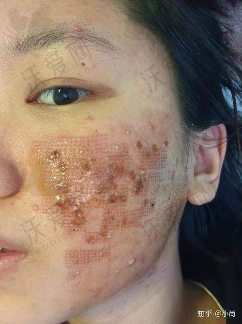 深圳悦尔医美痘坑痘印点阵激光修复技术有什么优势？