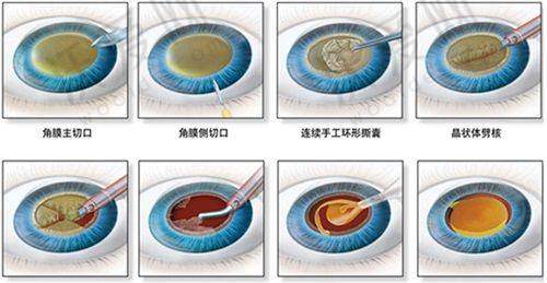 吉林大学第二医院眼科技术好不好？