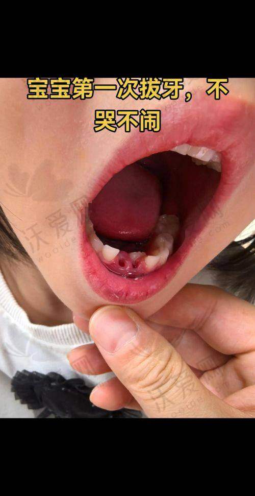 西安团圆口腔儿童乳牙拔除前后需要注意什么？