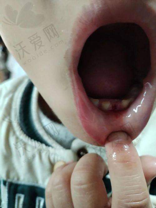 西安团圆口腔儿童乳牙拔除价格30元起一颗，无痛精准又消毒让孩子换牙没烦恼