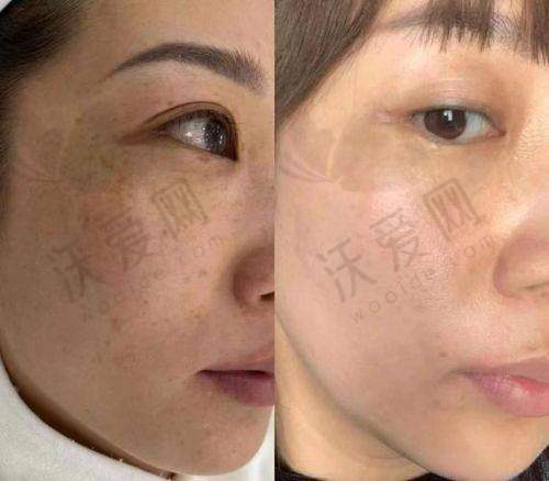 深圳悦尔医疗美容超皮秒淡疤修护技术有哪些优势？