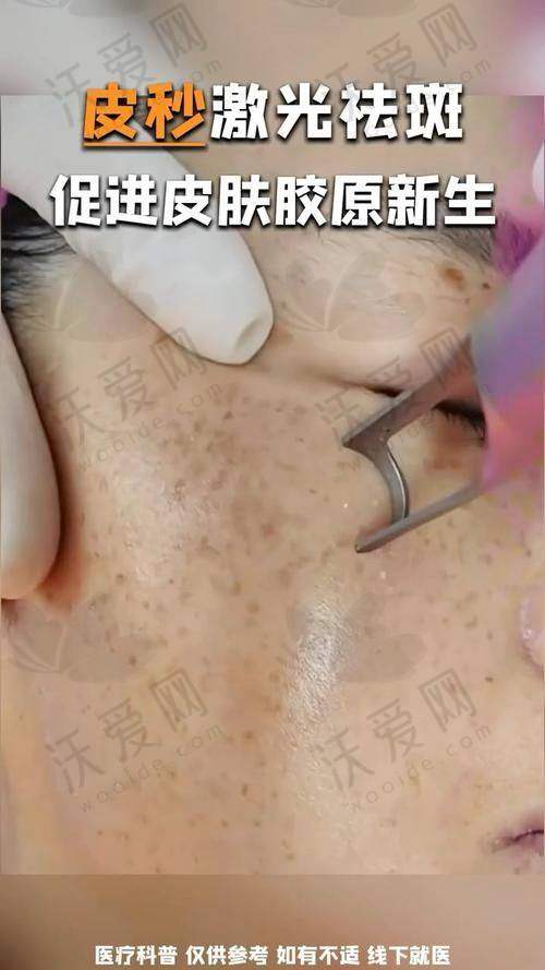 深圳悦尔医美超皮秒淡化咖啡斑的技术优势有哪些呢？