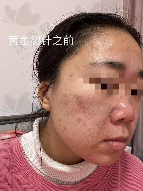 杭州浮想国医美点阵激光祛除痘坑/痘印的治疗成效