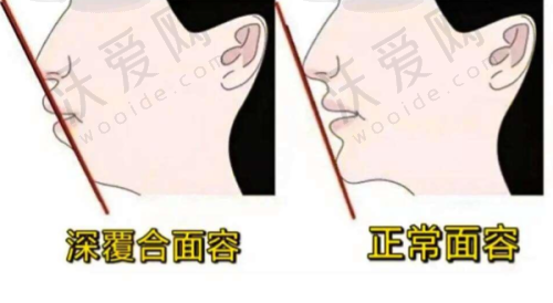 徐州鼎植口腔金属自锁托槽矫正价格11800元起，舒适速矫+多样方案开启美牙之旅