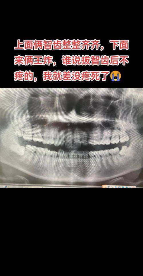 徐州鼎植口腔疑难阻生智齿拔除价格999元起一颗，技术优体验好多样项目超贴心