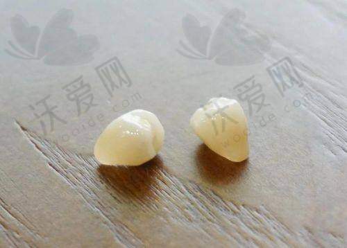 徐州鼎植口腔医院瑞士E-MAX全瓷牙价格1880元起，美观耐用售后好性价比超高！