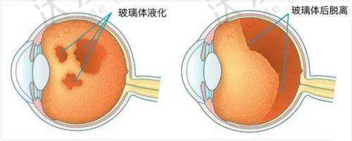 重庆千叶眼科陈费清院长白内障超声乳化价格6800元起，小切口快恢复助你重见清晰世界