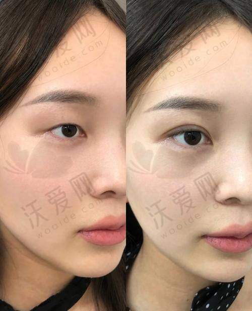 乌鲁木齐华美整形韩式三点定位双眼皮技术不错可靠