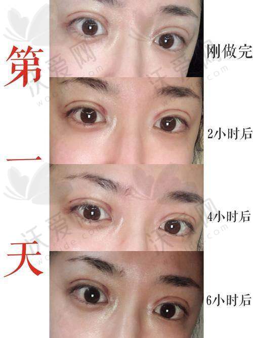 乌鲁木齐华美整形韩式三点定位双眼皮服务贴心周到