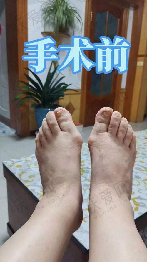 总结——沈阳和平马文足科整形外科门诊部‌曹海锟医生怎么样？