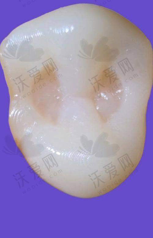 乌鲁木齐天牙口腔美国3M-Z250树脂补牙的出色技术