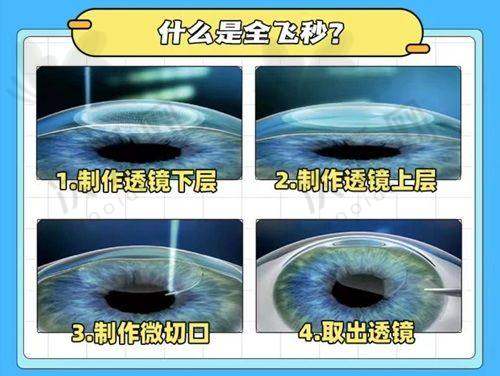 抚顺爱尔眼科方学军院长飞秒激光精细化雕刻C+近视手术有哪些优势？