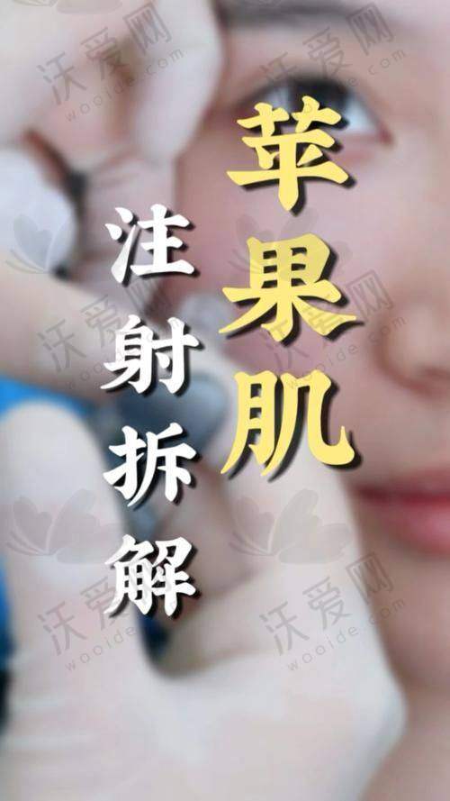 乌鲁木齐华美整形自体脂肪填充苹果肌的技术优势