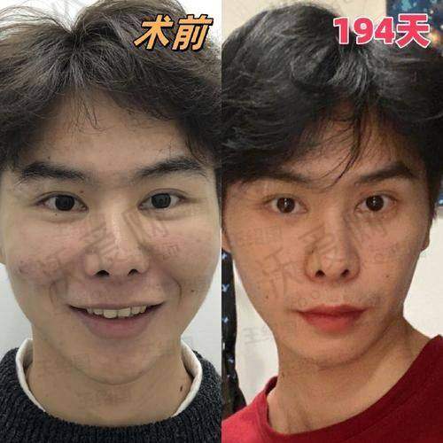 乌鲁木齐华美整形自体脂肪填充苹果肌的医院可靠性