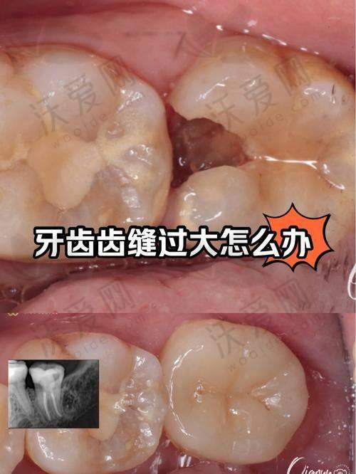 西安团圆口腔医院前牙根管治疗医生专精，实力护航保健康