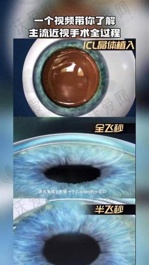 昆明华厦眼科医院ICL晶体植入手术有哪些优势？