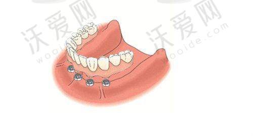 宁波牙博士口腔韩国仕诺康种植牙技术水平解析