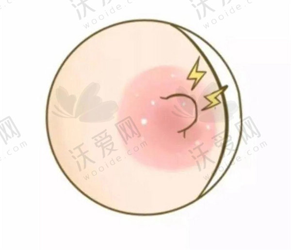 长沙祺美胸整形医院乳头内陷矫正单次单侧原价20000元,现5000元起享精尖胸整形技术