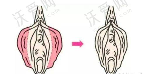 广州荔医医疗美容其他私密项目收费标准参考