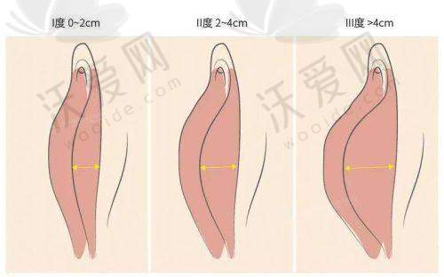 广州荔医医疗美容小阴唇手术值得选择