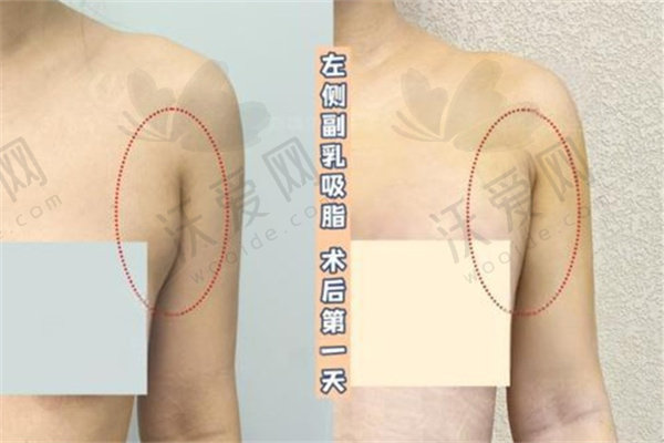 长沙祺美医疗美容副乳吸脂原价26463元,现仅3800元起享精尖胸整形技术