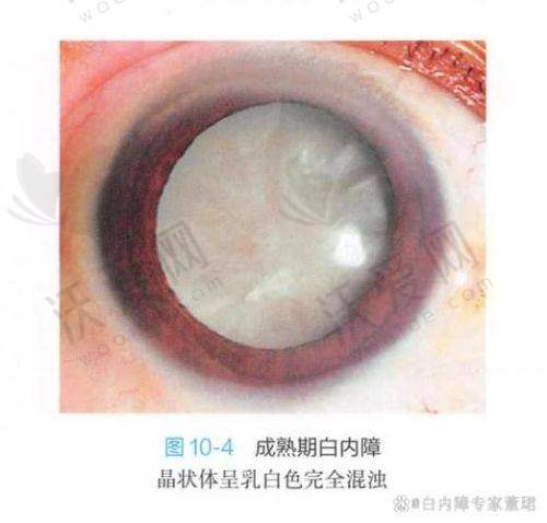 成都华厦眼科医院白内障三焦晶体植入术的流程是怎样的?