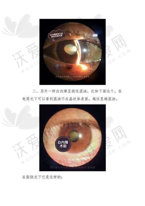 成都华厦眼科医院白内障三焦晶体植入术的优势
