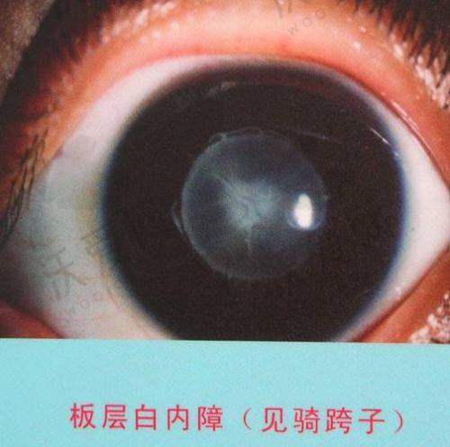 成都华厦眼科白内障三焦晶体植入30000元起,高视觉减并发还能个性定制