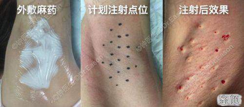 广州荔医医疗美容注射治疗狐臭的技术亮点