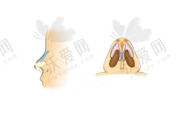 重庆当代整形王旭明隆鼻