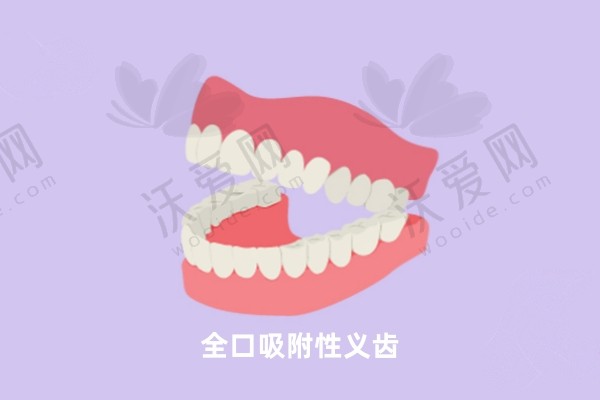 北京中诺口腔全口吸附性义齿